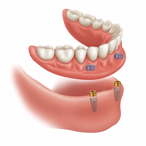 インプラント義歯　ロケーターアバットメント