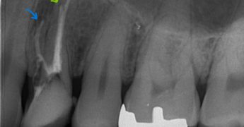 上顎第一小臼歯の3根管　ニッケルチタンファイル　山梨　あいざわ歯科クリニック