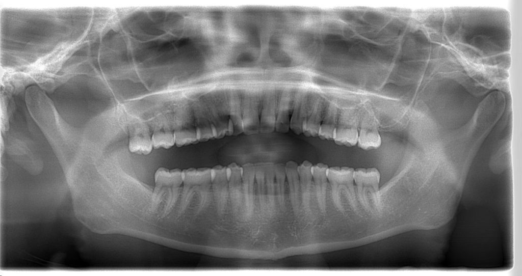 パノラマ断層撮影の位置付け　あいざわ歯科クリニック