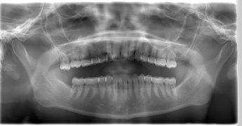 パノラマ断層撮影の位置付け　あいざわ歯科クリニック