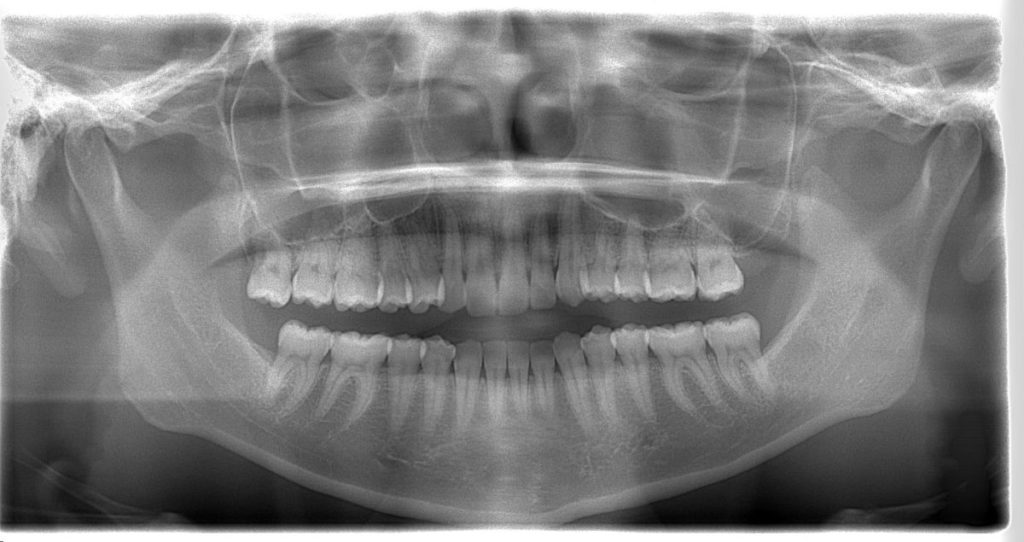 パノラマ断層撮影の位置付け　あいざわ歯科クリニック