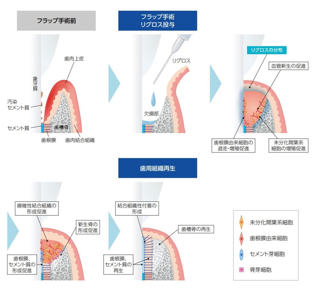 リグロスの歯槽骨再生手術　あいざわ歯科クリニック2025